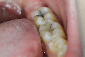 Image result for Tooth Buckle Filling