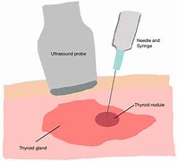 Image result for Thyroid Nodules Size
