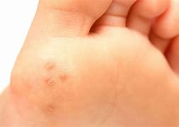 Image result for Are There Different Types of Warts