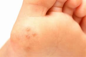 Image result for Types of Warts Skin Tags