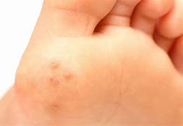 Image result for Types of Warts