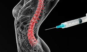 Image result for Facet Injections for Back Pain