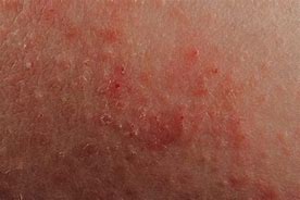 Image result for Severe Eczema