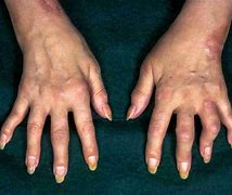 Image result for Polyarthritis of Right Hand