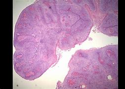 Image result for penile cancer
