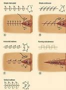 Image result for Sutures vs Stitches
