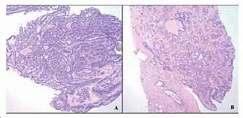 Image result for Papilloma On Neck
