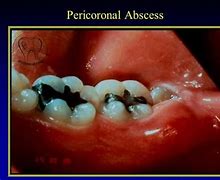 Image result for Periapical Abscess On OPG