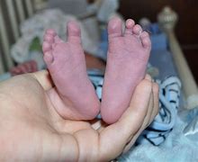 Image result for Blue Baby Syndrome