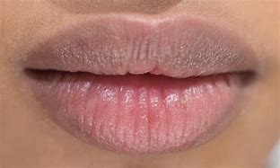 Image result for Chapped Lips From Cold Wind