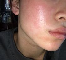 Image result for Allergy Bumps