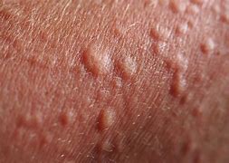 Image result for Heographic Skin Lunps