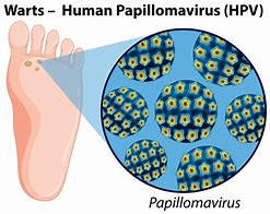 Image result for Papilloma Wart Virus