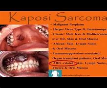 Image result for Kaposi Sarcoma