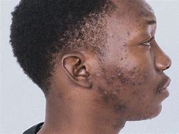 Image result for Acne Black Skin