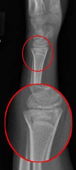 Image result for Torus Fracture