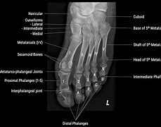 Image result for Foot Bones X-ray