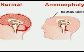Image result for Anencephaly Diagram