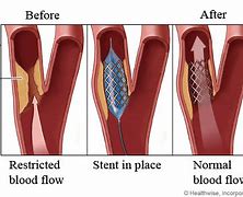 Image result for Carotid Artery Angioplasty with Stenting