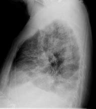 Image result for Chlamydia Pneumoniae CXR