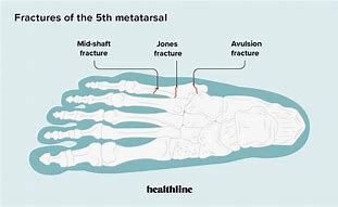 Image result for Non-Union 5th Metatarsal Fracture