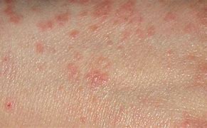 Image result for Scabies Skin Disease