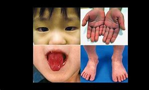 Image result for Kawasaki Disease in Adults