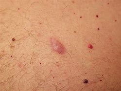 Image result for Lumps Under Your Skin