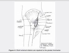 Image result for Rotator Cuff U-shaped Clip