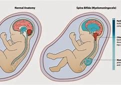 Image result for Spina Bifida Prevention