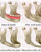 Image result for Bone Loss Dentures