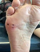 Image result for Plantar Warts Black Dots On Feet