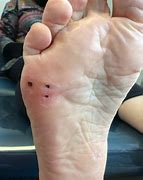 Image result for Plantar Wart Hole in Foot