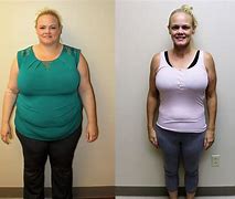 Image result for Weight Loss Surgery