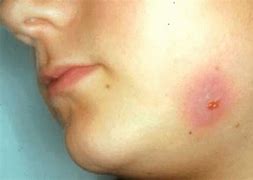 Image result for axtinomicosis