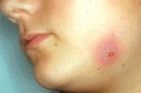 Image result for actimomicosis