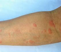 Image result for Allergic Reaction Skin Flare Up
