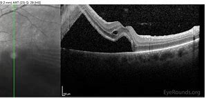 Image result for Retinal Tear Oct