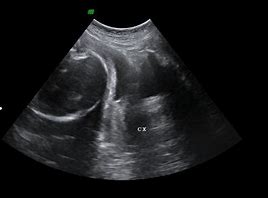 Image result for Fetal Ascites Ultrasound