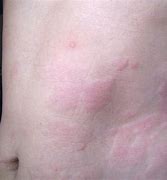 Image result for Skin Rash Hives Treatment