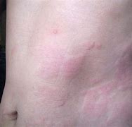 Image result for Benadryl Allergic Reaction Rash