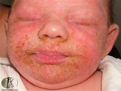 Image result for Severe Eczema