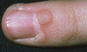 Image result for Beginning of Wart On Finger