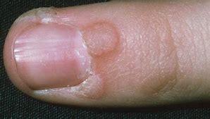 Image result for Fingernail Warts
