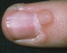 Image result for Verruca Finger