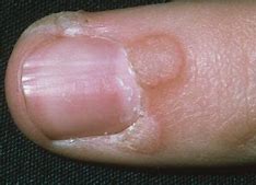 Image result for Small Finger Wart