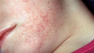 Image result for Leukemia Red Spots