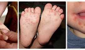 Image result for Hand Foot Mouth Disease