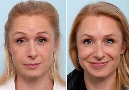 Image result for Before and After Botox around Mouth