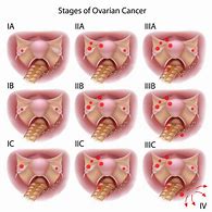 Image result for Ovarian Carcinosarcoma